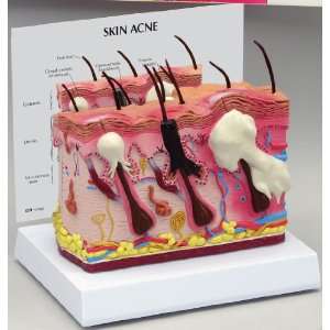  Acne Skin Cross Section Anatomical Model: Beauty