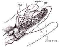 Ehl Tendon